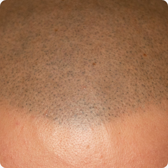 Nano Haarpigmentierung bei Elithair